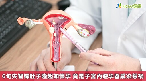 6旬失智婦肚子隆起如懷孕 竟是子宮內避孕器感染惹禍