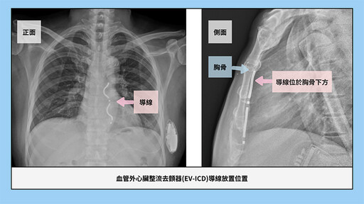 51歲男突發心因性猝死 新式血管外去顫器技術成功救回