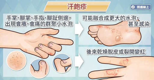 發癢小水泡常無預警突襲手腳？ 醫傳授6招遠離汗皰疹