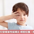 感冒鼻塞竟引發蜂窩性組織炎 眼瞼紅腫、疼痛愛注意！