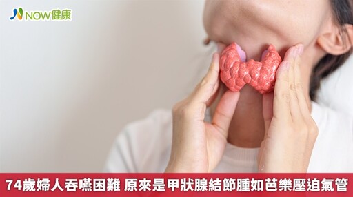 74歲婦人吞嚥困難 原來是甲狀腺結節腫如芭樂壓迫氣管