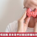 74歲婦人吞嚥困難 原來是甲狀腺結節腫如芭樂壓迫氣管