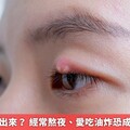 針眼突然冒出來？ 經常熬夜、愛吃油炸恐成誘發導火線