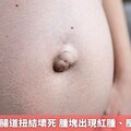 臍疝氣恐致腸道扭結壞死 腫塊出現紅腫、壓痛要注意！