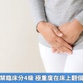應力性尿失禁臨床分4級 極重度在床上翻個身也會漏尿