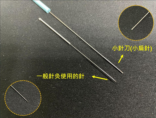 肩頸疼痛引起失眠、血壓高 小扁針療法助循環鬆解頑痛