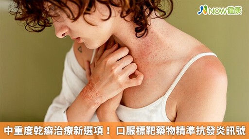 中重度乾癬治療新選項! 口服標靶藥物精準抗發炎訊號