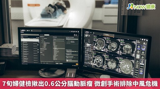 7旬婦健檢揪出0.6公分腦動脈瘤 微創手術排除中風危機