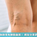 久站、久坐族群常有靜脈曲張！ 網友分享舒緩改善經驗