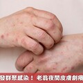 疥瘡極易引發群聚感染！ 老翁夜間皮膚劇癢竟疥蟲上身