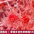 漸進性的血液癌症！ 掌握多發性骨髓瘤4大症狀早治療