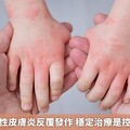 中重度異位性皮膚炎反覆發作 穩定治療是控制病情關鍵