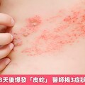 男側腹疼痛3天後爆發「皮蛇」 醫師揭3症狀須提高警覺