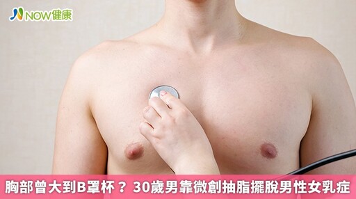 胸部曾大到B罩杯? 30歲男靠微創抽脂擺脫男性女乳症