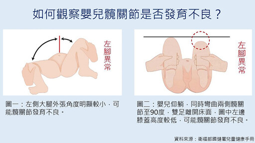 孩子換尿布髖關節發出怪聲 父母觀察2大重點及早診治
