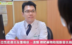 異位性皮膚炎反覆癢疹、潰爛 標靶藥物助阻斷發炎路徑