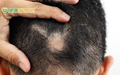 「鬼剃頭」可能是新冠肺炎、新冠疫苗所致 頭髮掉光光！圓禿該如何治療？