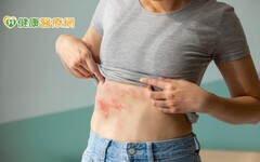 肌膚開始麻癢刺痛 小心可能是帶狀疱疹發病前兆