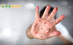 【闢謠】感染麻疹可獲抗體！？ 輕忽恐釀重症與嚴重併發症