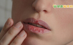 護唇膏越塗越糟糕 可能對成分過敏！