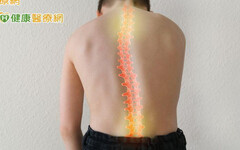 脊椎側彎中醫怎麼治療？ 針灸、用藥、復健三管齊下