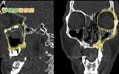 「顏面骨折」未妥善治療恐影響眼睛、咬合！ 導航技術助1男精準重建顏面