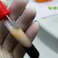 高血脂盛行率已達3成！ 血脂要看哪些檢測指標？怎麼做才能有效控脂？