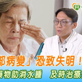 「黃斑部病變」恐致失明！雙機轉藥物助消水腫 及時治療搶救視力