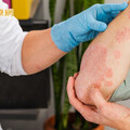 不是一般乾癬！「全身膿疱性乾癬」恐致器官衰竭 勿輕忽皮膚膿疱、脫屑