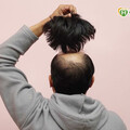 禿頭想要戴假髮？皮膚醫：配戴不慎恐加劇問題 應及早了解掉髮真正原因