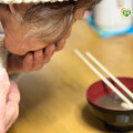 用餐突吐血竟是肝硬化 緊急手術用「橡皮圈」成功救命