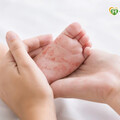 新生兒「腸病毒」流行中！ 感染併發重症6年同期最高