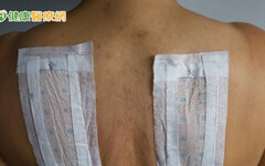 一變天就鼻塞？中醫師：三伏貼改善鼻炎有幫助 但這些人要慎用