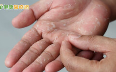 汗皰疹起水泡癢到無法工作 中醫分型調理體質助重返崗位