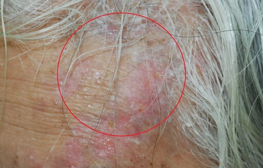 左側頭痛像遭雷擊！72歲男「額頭紅腫」竟是帶狀疱疹 醫曝三原因誘發