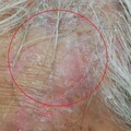 左側頭痛像遭雷擊！72歲男「額頭紅腫」竟是帶狀疱疹 醫曝三原因誘發