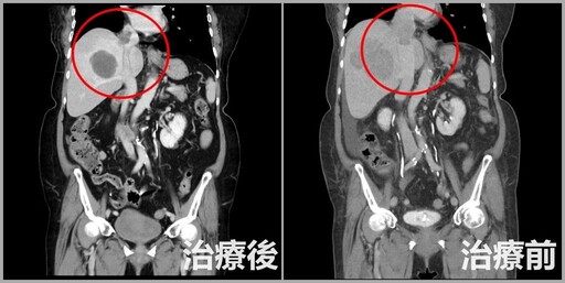 79歲婦腿腫爬樓梯狂喘！就醫驚見「13公分巨瘤+7公分血栓」 醫：晚期了