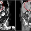 79歲婦腿腫爬樓梯狂喘！就醫驚見「13公分巨瘤+7公分血栓」 醫：晚期了