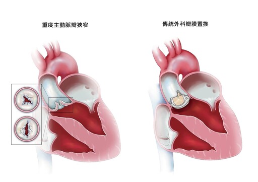 整理包／心臟瓣膜置換手術、材料怎麼選？心臟外科醫師一次說明白