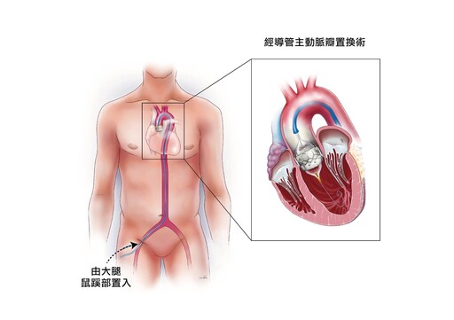 整理包／心臟瓣膜置換手術、材料怎麼選？心臟外科醫師一次說明白