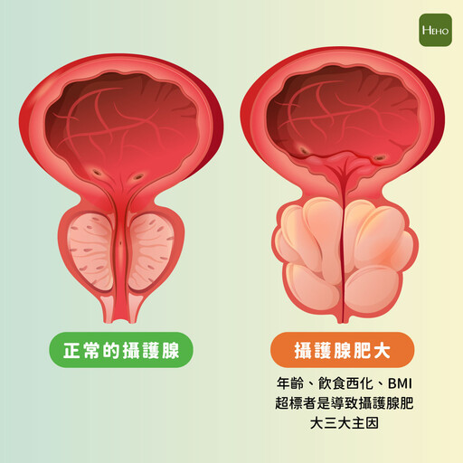 拋開刻板印象！面對攝護腺肥大別害怕 新式微創手術來助力