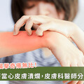 蚊子咬一包該怎麼辦？她塗蒜泥險潰爛 皮膚科醫師教正確處理法