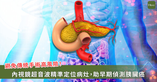 內視鏡超音波 + 健保給付,助胰臟炎免開大刀、揪早期胰臟癌