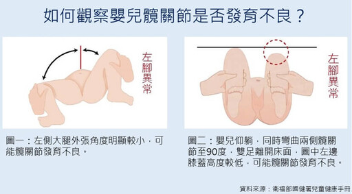 寶寶走路怪怪的？骨科醫師鄭士豪：2 招檢測髖關節發育不良徵兆，掌握黃金治療期