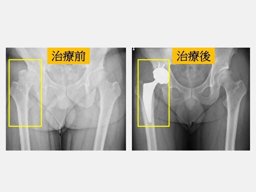 擺脫早發性髖關節炎 微創正前開人工髖關節手術助重返球場