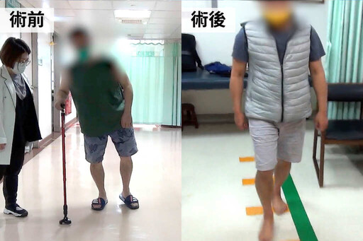 清醒手術助攻 彰基成功執行精準帕金森氏症DBS療法
