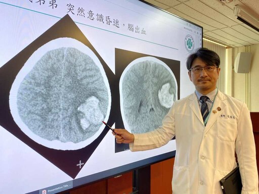 新式經靜脈血管造影術結合AR導航 台中榮總精準腦內「拆彈」救童