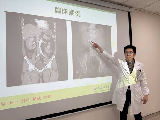 久坐少喝水兩年三度腎結石 體外震波不成卻以「軟」擊石成功