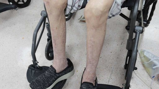 走路常跌不一定是骨鬆 75歲嬤驚見「肌少症」藏危機
