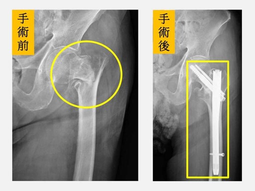 9旬阿祖髖關節骨折 中西醫整合照護2週出院享天倫